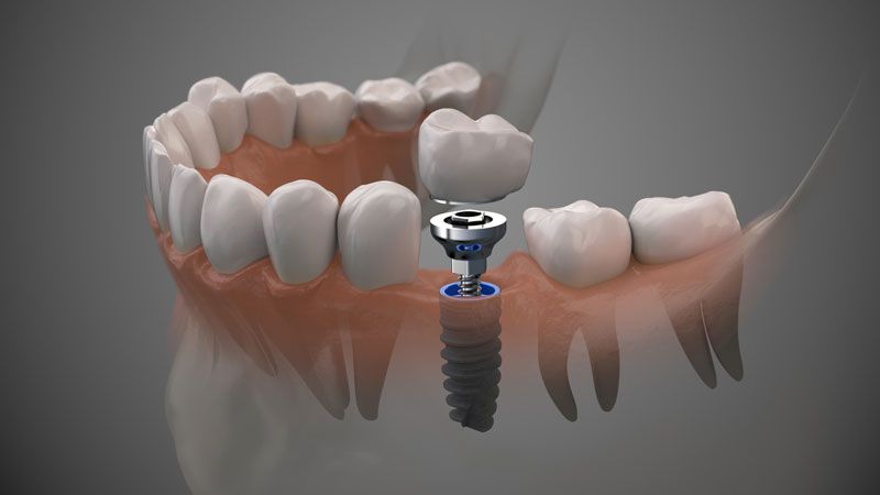 Dental implants in Costa Rica